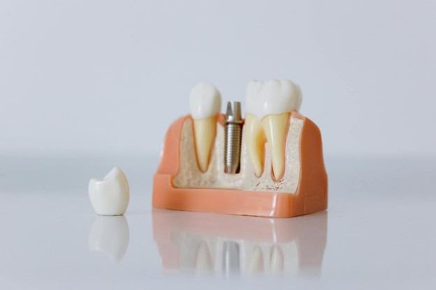 7 Innovations in Dental Veneers That Are Improving Patient Experience in 2026