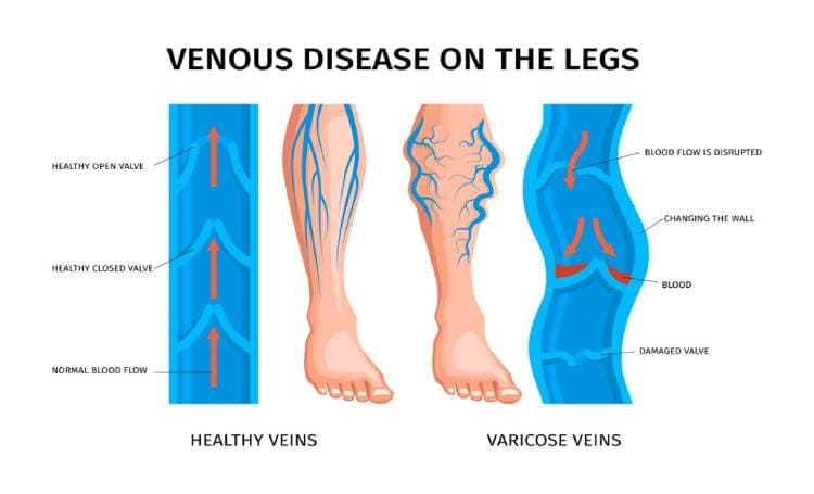 Early Detection of Varicose Veins: Essential Technologies for Diagnosis